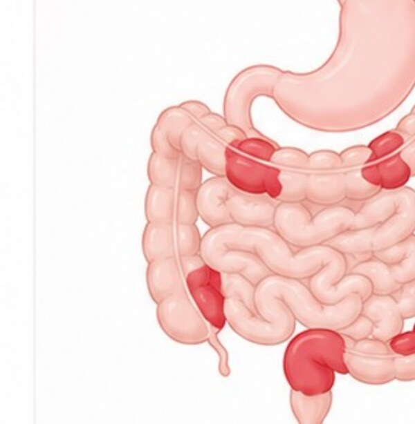 Illustration of the digestive tract showing patchy inflammation in Crohn's disease
