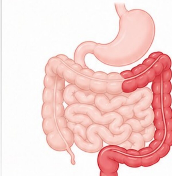 Illustration of the digestive tract showing continuous inflammation in the colon and rectum in ulcerative colitis